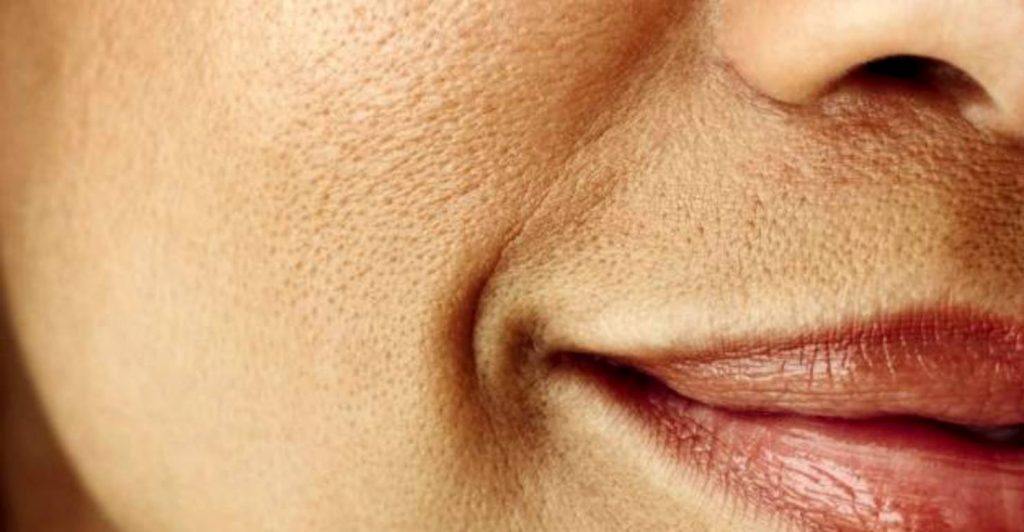 Pori dilatati: cosa c'è da sapere (e come evitarli)